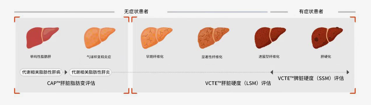 FibroScan? 檢查可為各種肝臟疾病的治療決策提供依據(jù)